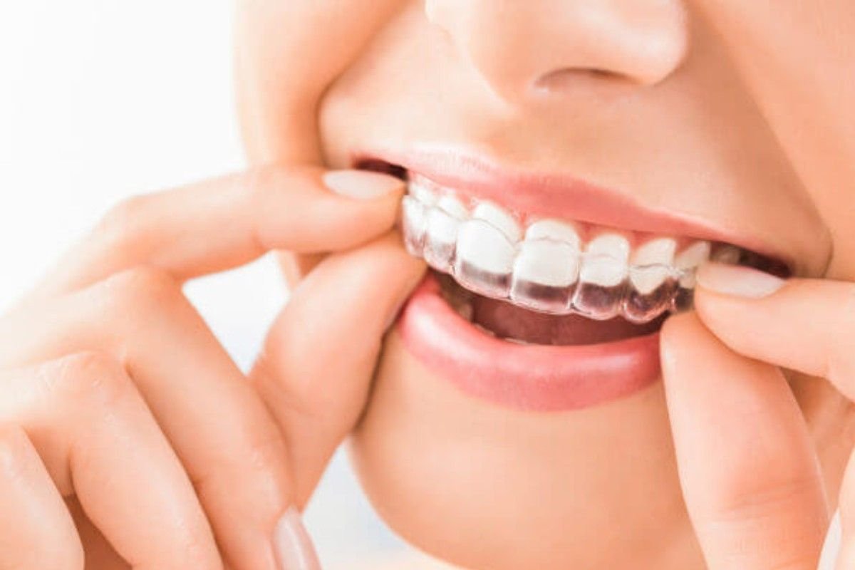 Invisible Aligner